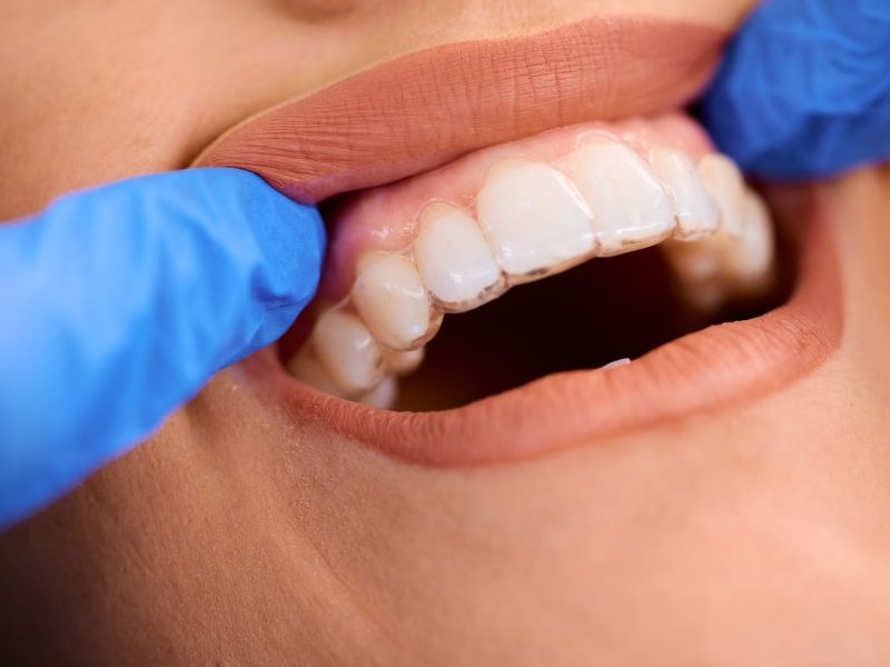 Tanden bleken – Mondzorg jekerdal Tanden bleken - Mondzorg jekerdal