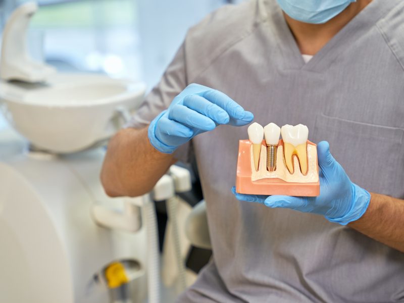 Mondzorg Jekerdal Implantaten